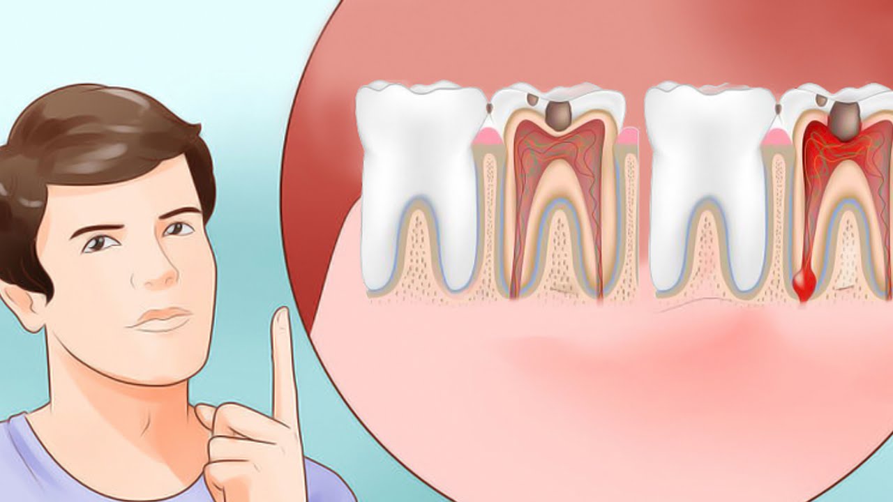 ból zęba - leczenie kanałowe